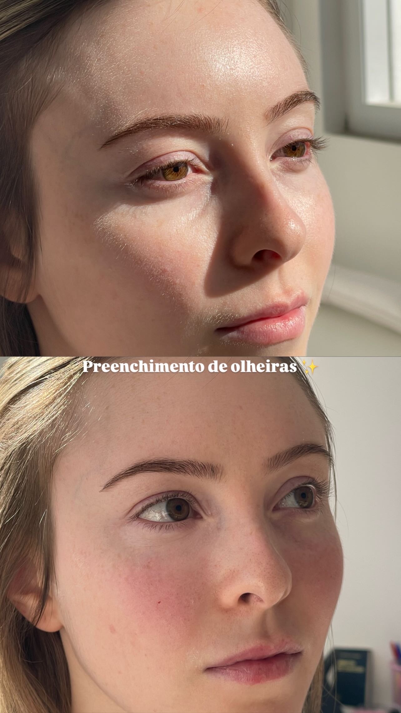 Resultado — Antes e Depois